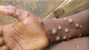 Mpox Global Health Emergency
