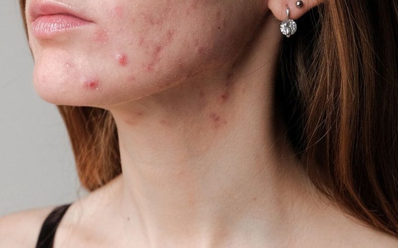 How to Get Rid of Acne
