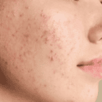 How to Get Rid of Acne