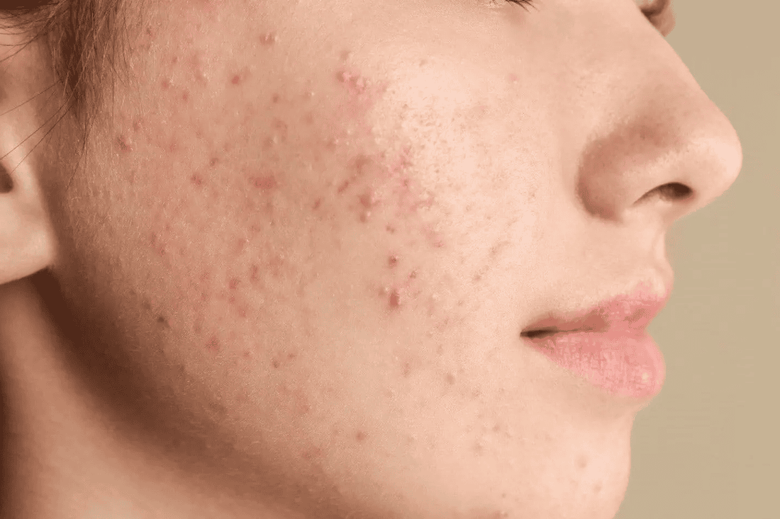 How to Get Rid of Acne