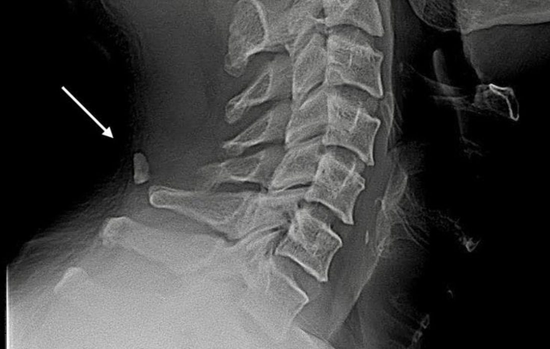 C6 Vertebra Anatomy