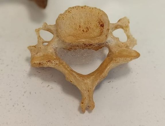 C6 Vertebra Anatomy