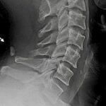 C6 Vertebra Anatomy
